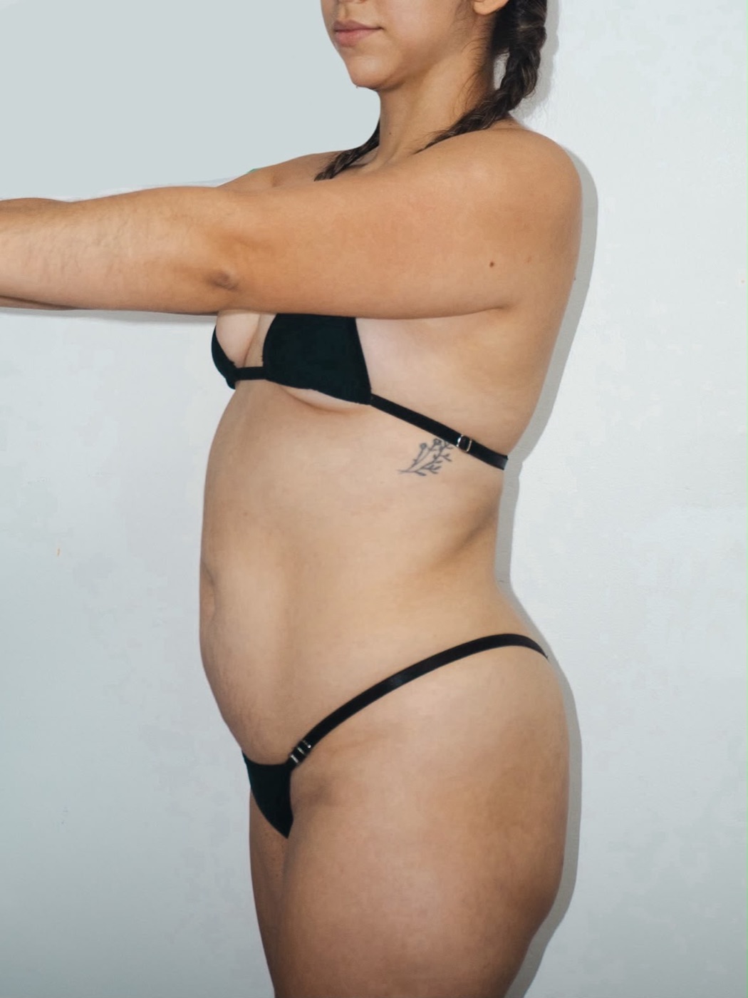 Resultado real — lipoescultura