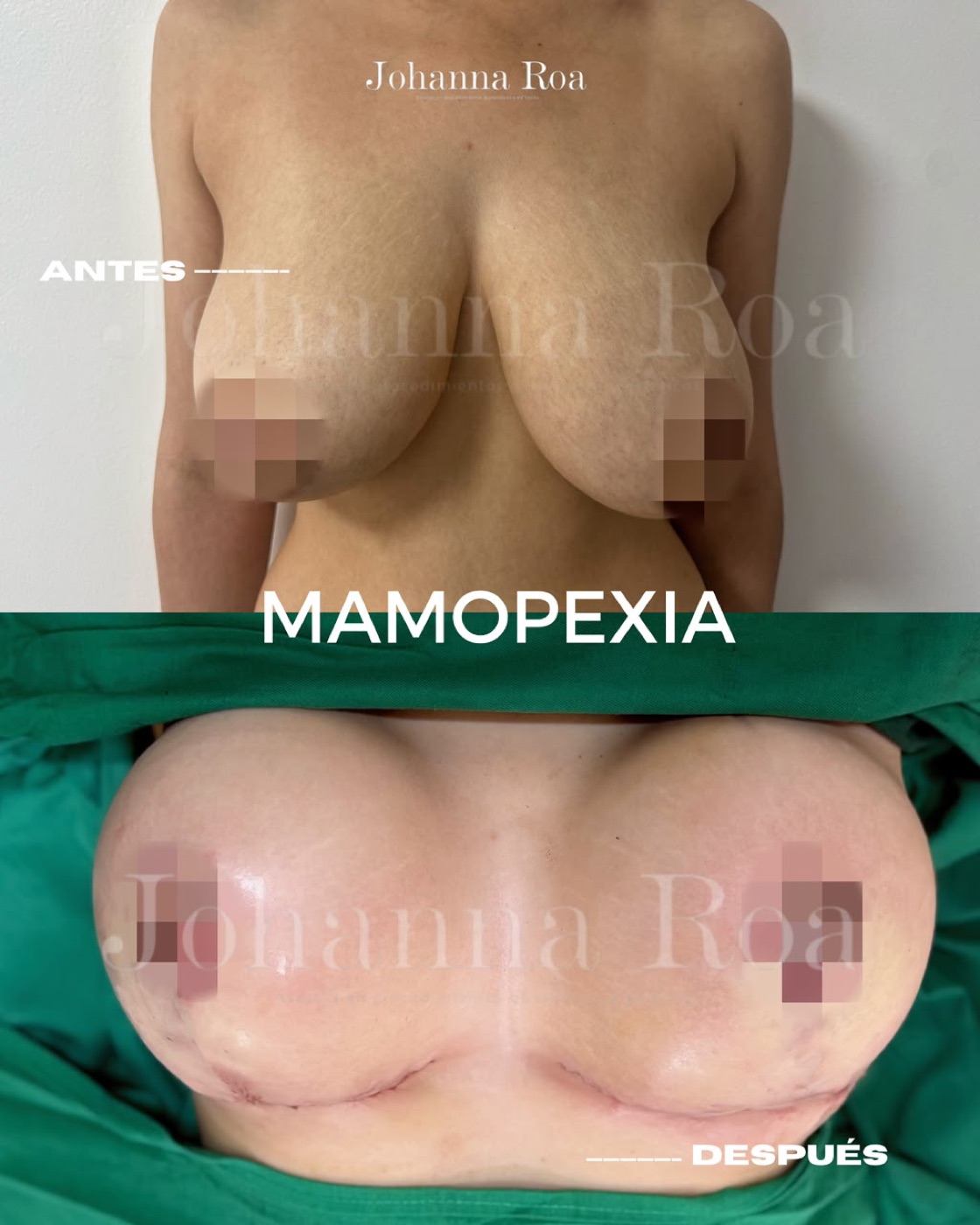 Resultado real — mamopexia