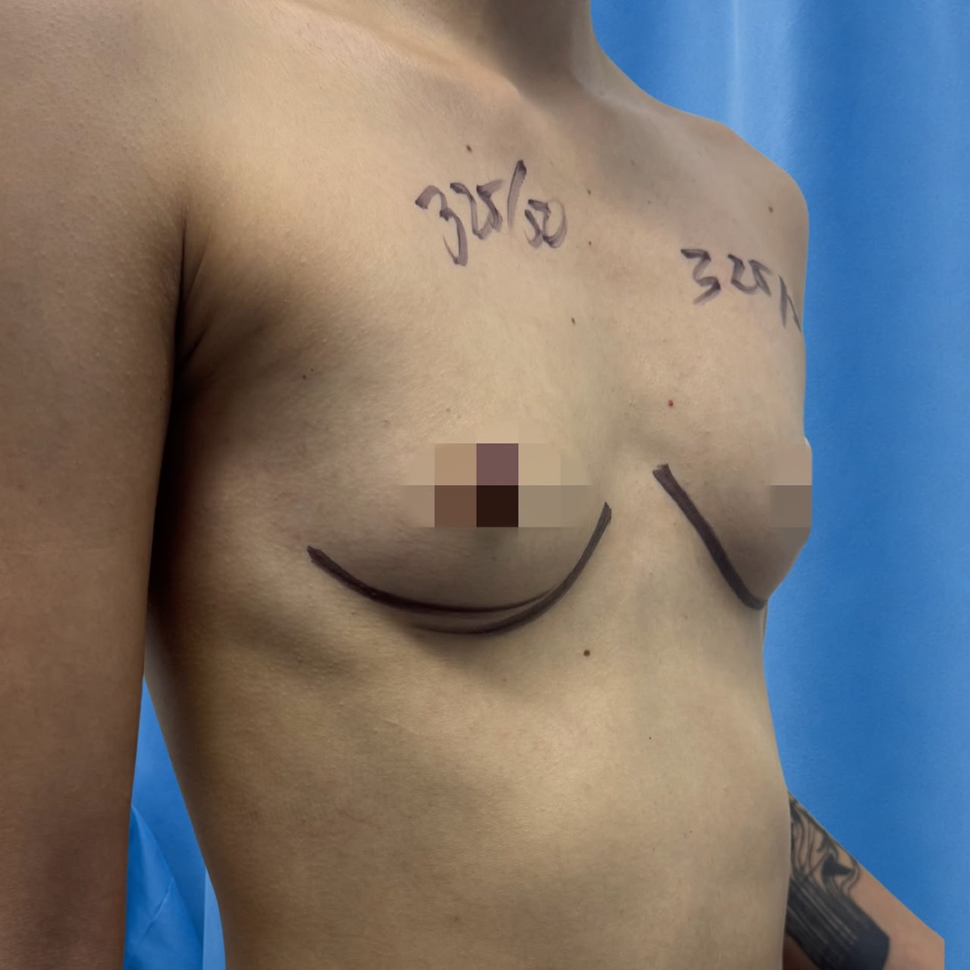 Resultado real — mamoplastia-aumento